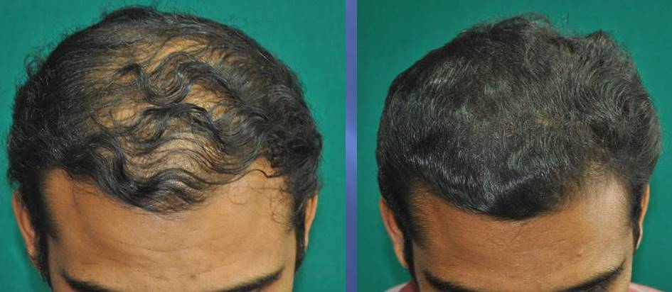 Best Permanent Hair Fixing Cost in Bangalore Bangalore  QuickFinds